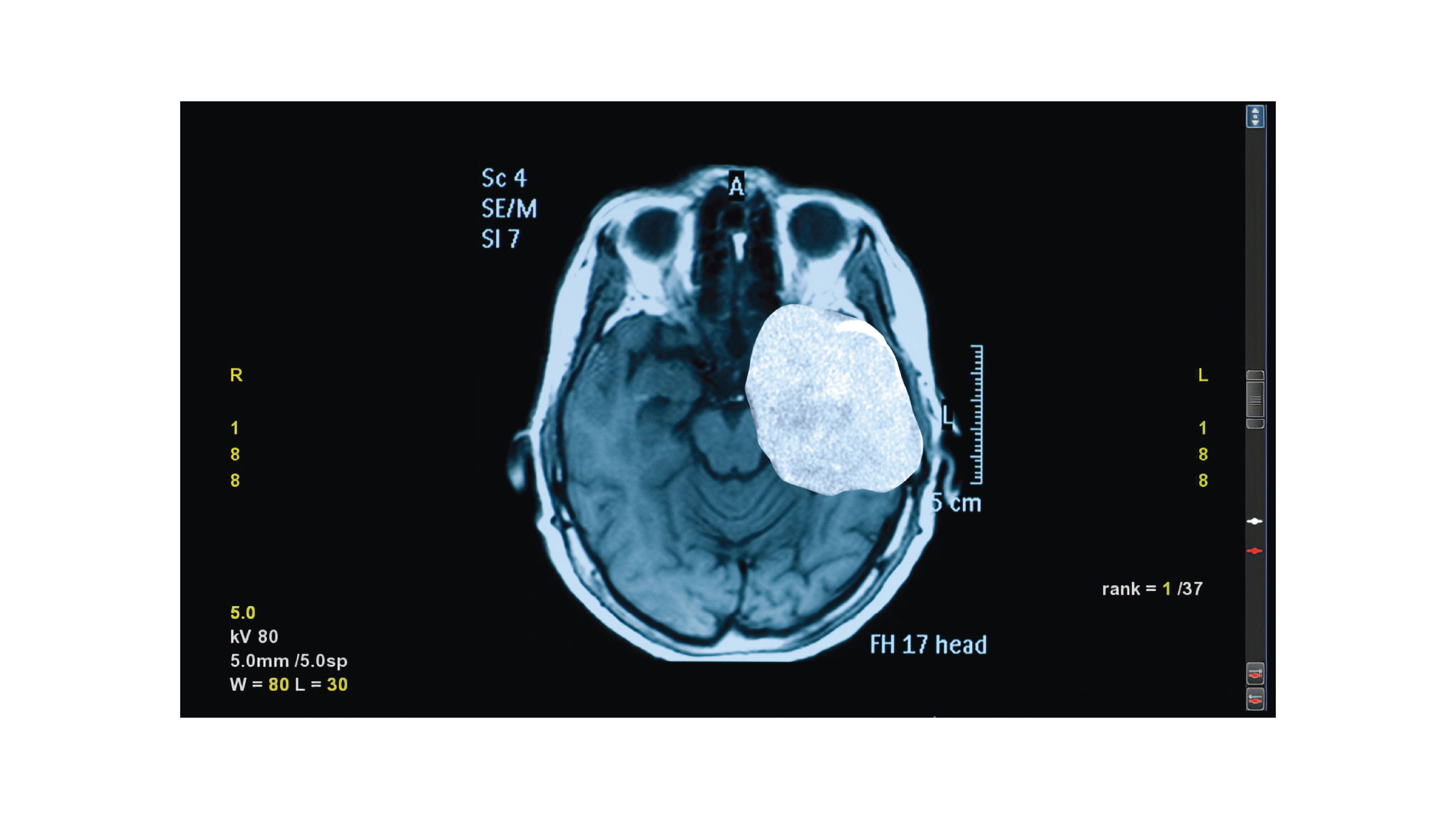 MRI/MRA Scan