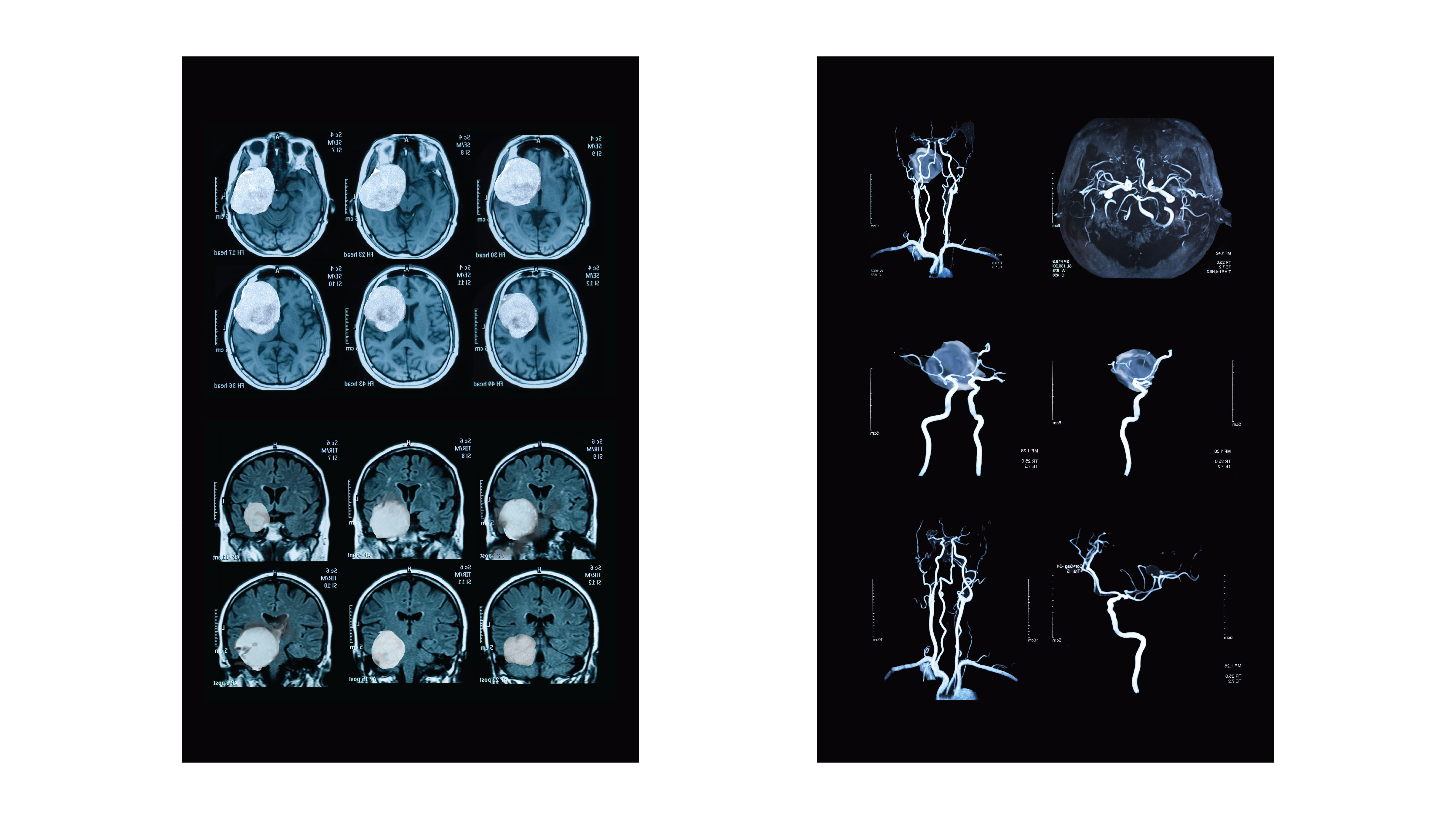 MRI/MRA Scan